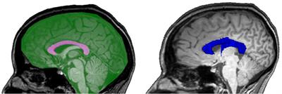 Comparison of Manual Cross-Sectional Measurements and Automatic Volumetry of the Corpus Callosum, and Their Clinical Impact: A Study on Type 1 Diabetes and Healthy Controls